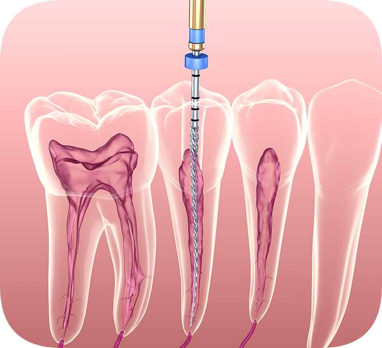 Trabzon Endodontic Root Canal Treatment Dentomed